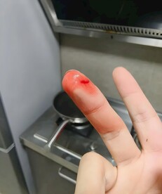 受伤的手指