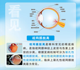 眼科医院视网膜脱离海报