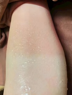 皮肤病