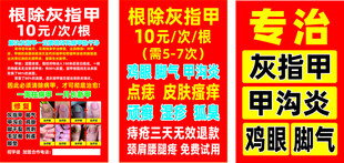 灰指甲 