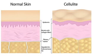 正常皮肤与橘皮组织对比