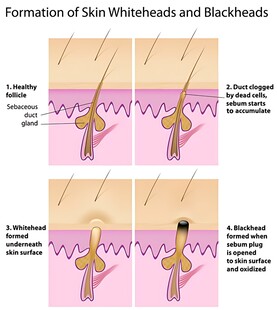白头黑头形成过程图示