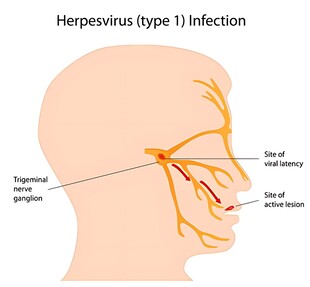 II型单纯疱疹病毒感染图示