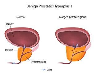 良性前列腺增生示意图