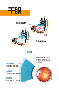 干眼