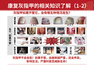灰指甲牌