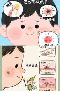 儿童脸部痘痘成因
