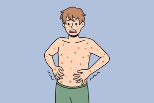 男子展示身上密集红疹