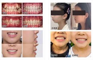 口腔正畸牙齿矫正前后对比图效果