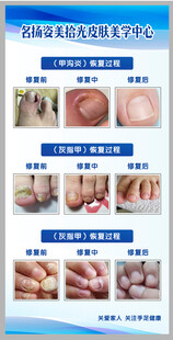 灰指甲