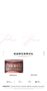 牙龈萎缩案例对比